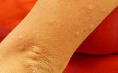 Uzroci alergije na sunce: što stoji iza neželjenih reakcija kože