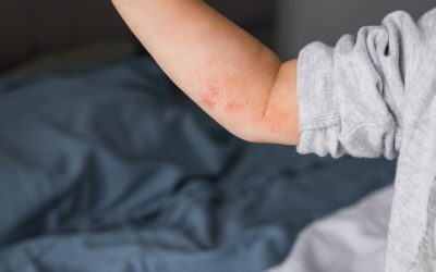 Kako se postavlja dijagnoza atopijskog dermatitisa?