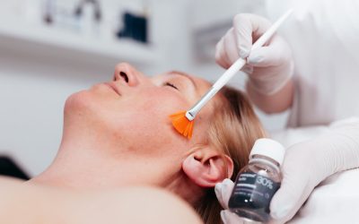 Put prema mirnoj koži: zašto akne traže strpljenje, a ne instant rješenja