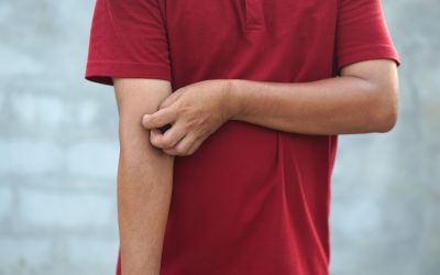 Kako izgleda koža kod osoba sa svrabom?