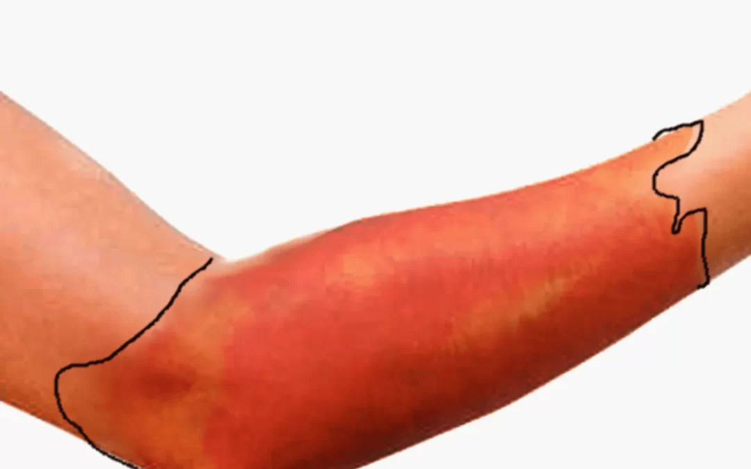 Kako razlikovati crveni vjetar od drugih kožnih upala, alergija i infekcija